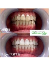 ホワイトニングサロン 名古屋駅店/【ホワイトニング施術例】