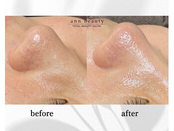 アン ビューティー(ann beauty)/施術1回【症例写真】30代