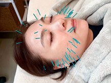 アオイ(Aoi)/美容鍼でむくみをとり小顔に