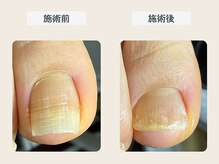 ルポ 伊勢/巻き爪ケア