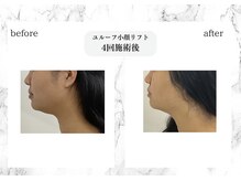 トキ(TOKI)/ユルーフ小顔リフト　4回目術後