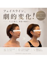 ポノティー(PONOTY)/次世代サーマ×脂肪コントロール
