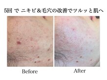 ナチュラーレ 天王寺店(Naturale)/美肌ニキビケア小顔フェイシャル