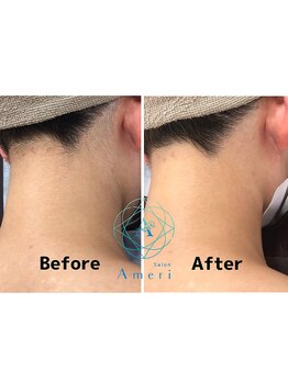 サロンアメリ イオンモール綾川店(Salon Ameri)/香川脱毛　うなじ脱毛　VIO脱毛