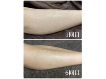 エース 赤坂の雰囲気（人気の足脱毛！施術５回目でほとんど毛が目立たなくなり美脚に★）