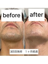 ラウラウ(laulau)/ヒゲ脱毛