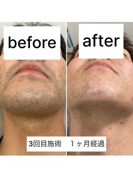 ラウラウ(laulau)/ヒゲ脱毛