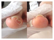 巻き爪ケアサポート ルアナ(LUANA)/Before→After
