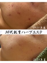 サロン ド エン(Salon de. en)/赤みニキビ◇ハーブピーリング