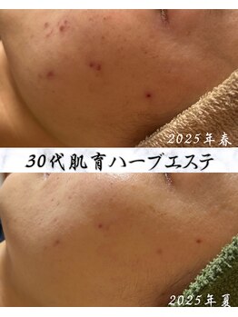 サロン ド エン(Salon de. en)/赤みニキビ◇ハーブピーリング