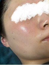 リノルーア(Linolua)/ニキビケアにはハーブピーリング