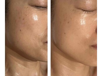 アドビューティ(Add Beauty)/≪プラズマフェイシャル≫