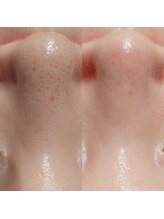 マイフェアレディ 今池(MyFairLady)/ハイドロフェイシャル毛穴洗浄