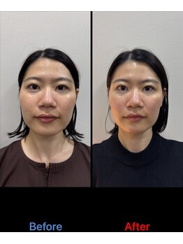 ラムーン(La.Moon)/小顔・美容鍼×フェイシャル