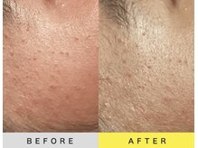 ソアン(Soin)/ダクトピール