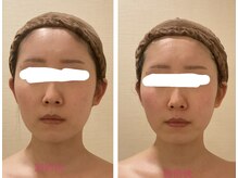 小顔コルギ専門店 フェルーシュ 成田駅前店(Feruche)/背中+小顔コルギ　1回目