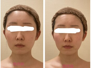 小顔コルギ専門店 フェルーシュ 成田駅前店(Feruche)/背中+小顔コルギ　1回目