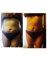 エンドリングフェイシャル専門サロン ムーンティア/インディバ痩身一回でスッキリ！