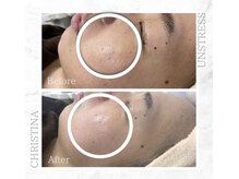 シャルムパリス(charme paris)/毛穴レス♪１回の施術変化