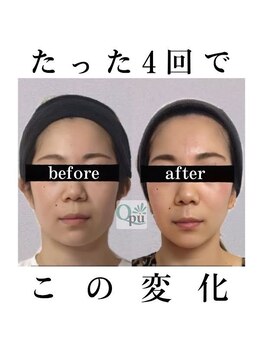 キュープ 大阪心斎橋店(Qpu)/たった4回でこの変化