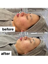 ココン(cocon)/肌改善