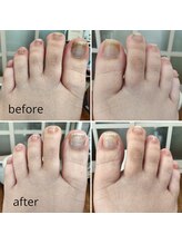 リゼランアンドコー 福島鎌田店(LIZERA&Co)/巻き爪矯正before/after◎