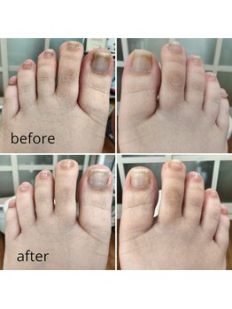 リゼランアンドコー 福島鎌田店(LIZERA&Co)/巻き爪矯正before/after◎
