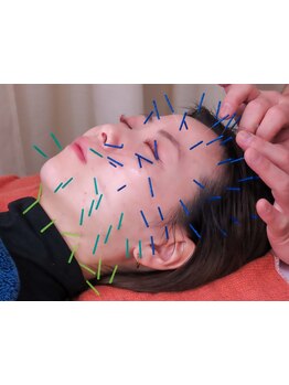 ホウレイ線・たるみ改善！予防ケア