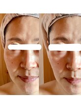 エステティックサロン ドゥネール/【1回小顔施術】美人小顔矯正