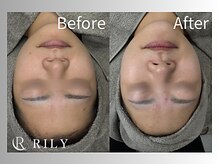 リリー(RILY)/【プラズマビフォーアフター】