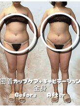 レチカ(Rechica)/吸い上げ（吸引）＋キャビ