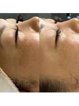 ウィンウィン 新山口店(Win Win)/目元のシワ改善