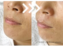 ニカット(nikatto)/フェイシャルワックスビフォアフ