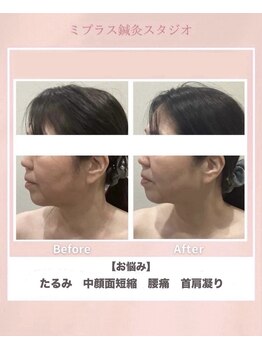 ミプラス鍼灸スタジオ/ビフォーアフター