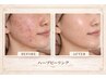 【本気の肌質改善】ハーブピーリング×小顔コルギ100分 ￥24,800→￥16,800