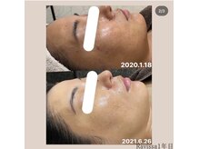 ミノ 美里大通り店(mino)/くすみ・糖化が気になる方へ♪