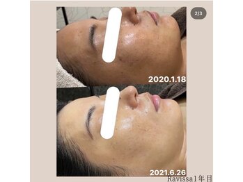 ミノ 美里大通り店(mino)/くすみ・糖化が気になる方へ♪