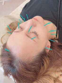 ヒーリングサロン アージュ(A-je)/★美顔鍼＋小顔矯正★