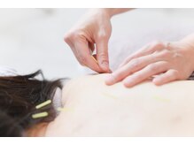 ハリシエール(Hariciere)/お顔だけではない美容鍼