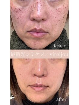プライベートアイラッシュサロン ヴィレージュ 稲毛店(Vireijou)/大人気のシミケアで悩み解決！