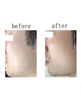 アゲハ(ageha)/メンズ/髭脱毛