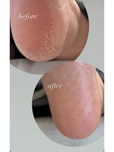 フットミー(foot mii)/かかとケア