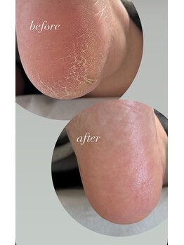 フットミー(foot mii)/かかとケア