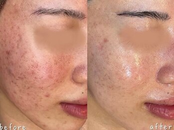 エヌエースキン たまプラーザ店(NAskin)/ハーブピーリング|ニキビケア