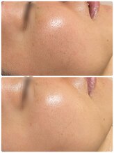 ケイサロン 朝霞店(K salon)/顔脱毛