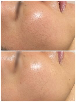 ケイサロン 朝霞店(K salon)/顔脱毛