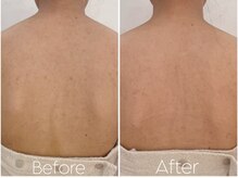 カレンジェビューティー(CarengeBeauty)/背中ニキビケア