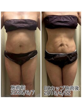 クールスパ(COOL SPA)/50代女性 お腹症例