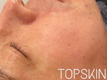 トップスキン 名駅(TOPSKIN)/メンズフェイシャルも人気です♪
