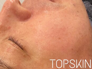 トップスキン 名駅(TOPSKIN)/メンズフェイシャルも人気です♪